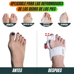 ✨ ¡Lleva tu Corrector Ortopédico para Juanetes por solo Q199  + ENVÍO GRATIS a toda Guatemala!✨